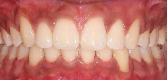 Deep overbite