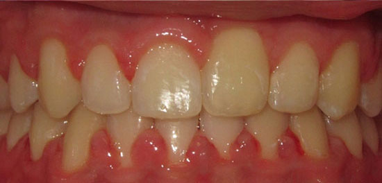 Underbite