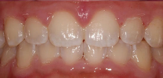 Overbite